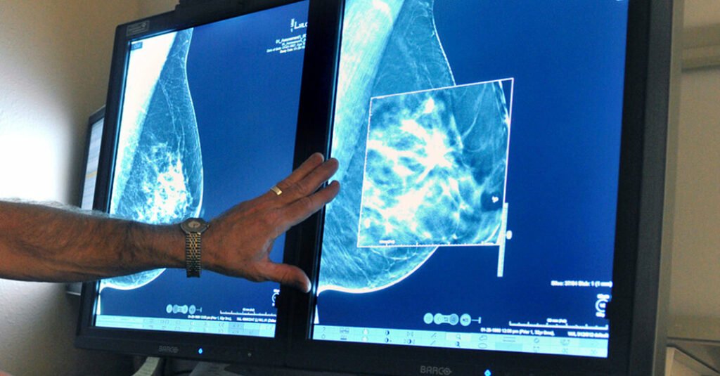09mammograms sb facebookJumbo Newspack United States